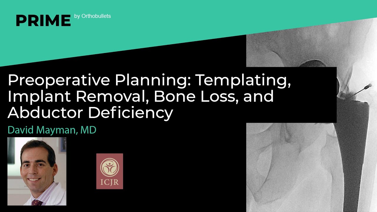 Pre-op Planning: Templating, Implant Removal, Bone Loss, and Abductor Deficiency - David Mayman, MD