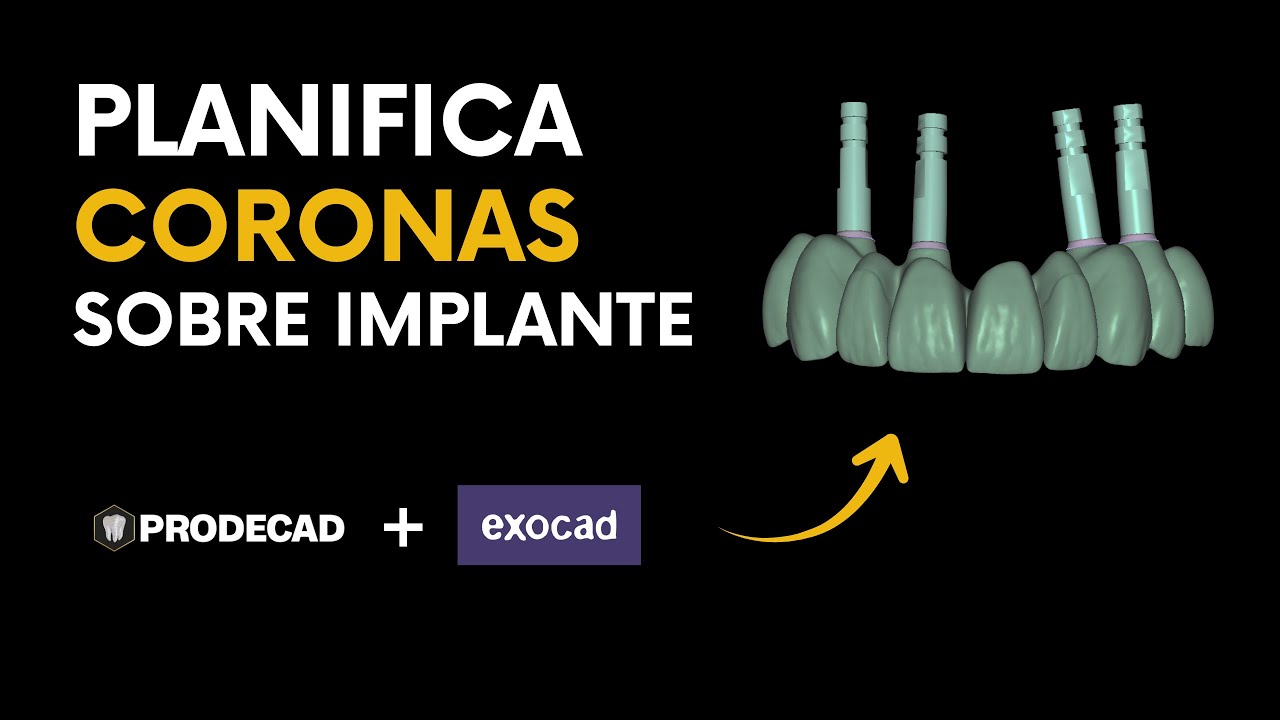 Exocad para PRINCIPIANTES - Planificar coronas sobre implante