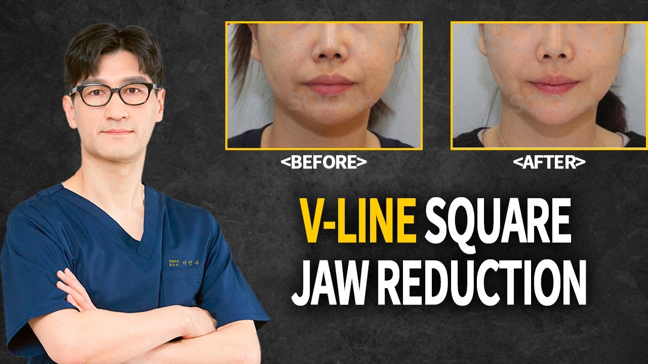 Korean Plastic Surgery's Square Jaw Surgeons | Jaw surgery | Before After
