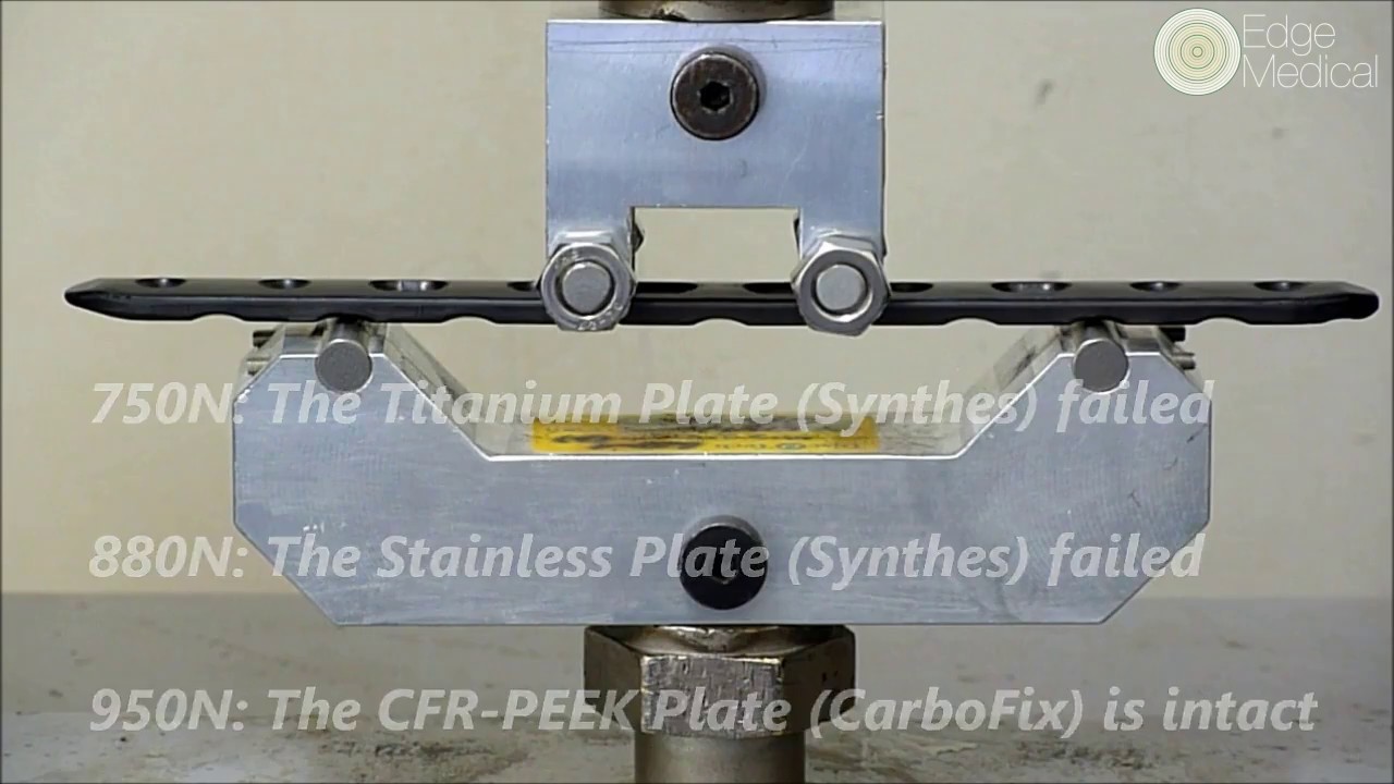 CARBOFIX   COMPLEX FRACTURE MANAGEMENT   COMPARISON