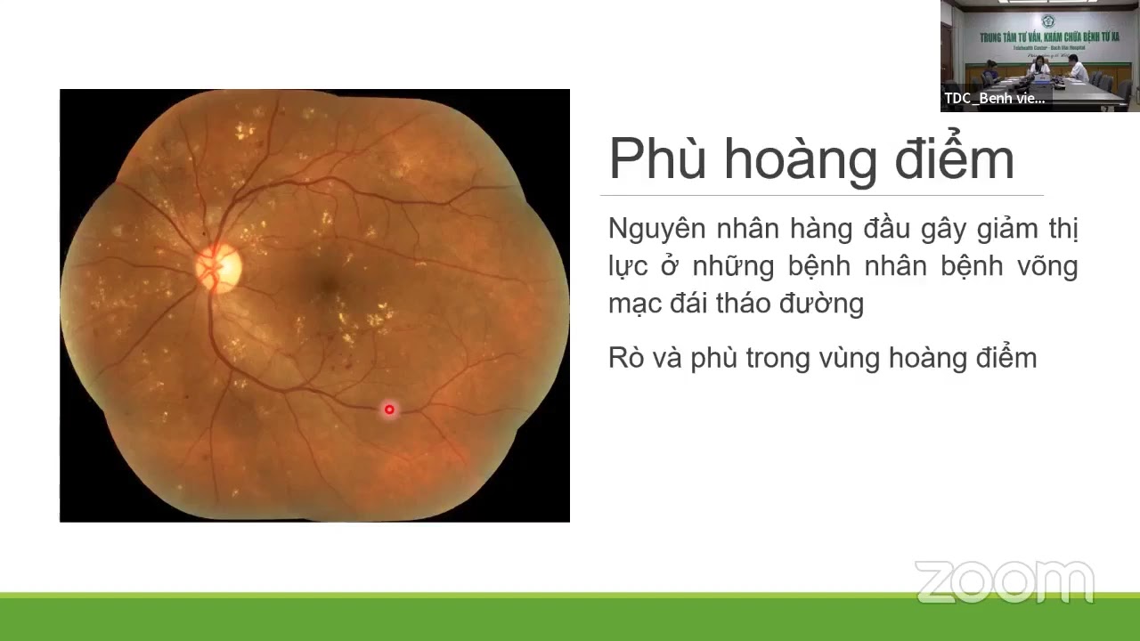 Bệnh võng mạc đái tháo đường