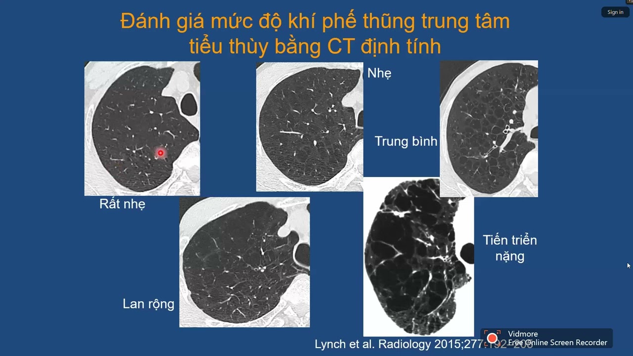 VAI TRÒ X-QUANG VÀ CT NGỰC TRONG HEN VÀ COPD | TS. BS. Nguyễn Văn Thọ