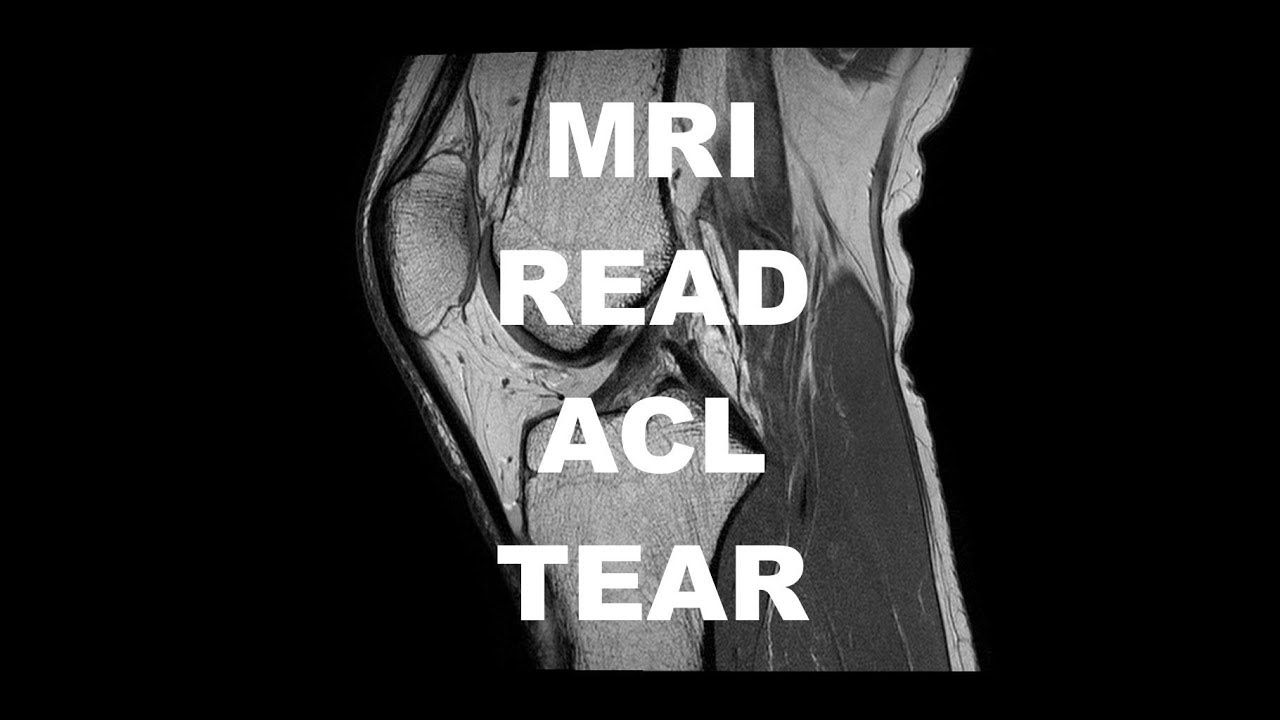Basic MRI Evaluation of an ACL Tear