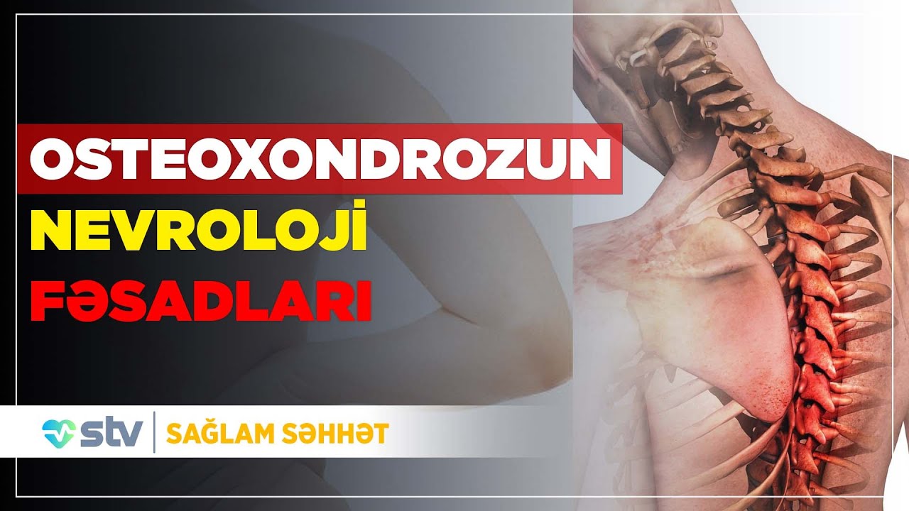 OSTEOXONDROZUN NEVROLOJİ FƏSADLARI