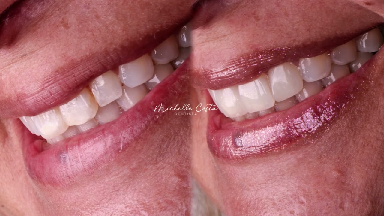 Resultado de Lentes de Resina: Transformação Real em Poucas Horas 😍