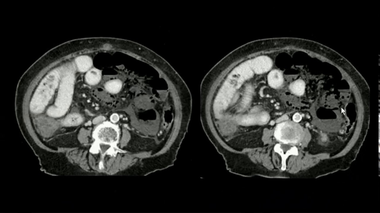 Pneumatose intestinal