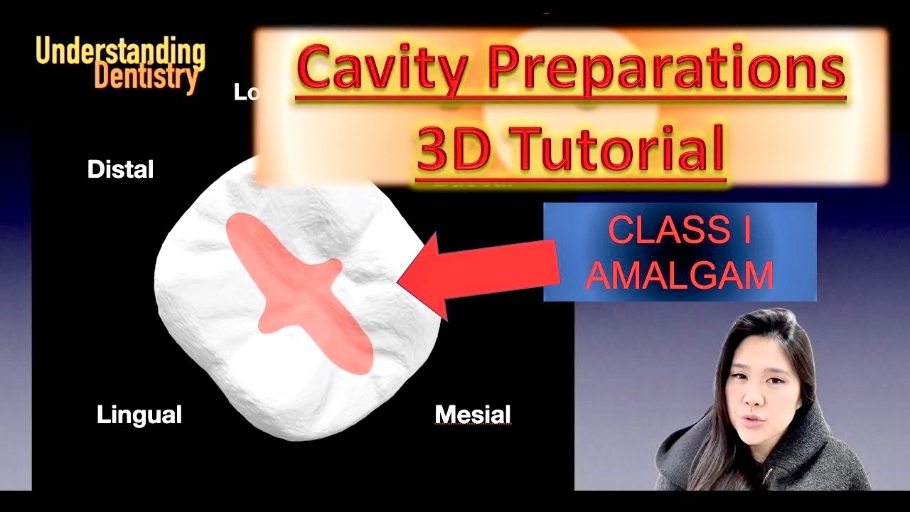 Class I Cavity Preparation with All Angles: 3D Tutorial Class 1 Amalgam