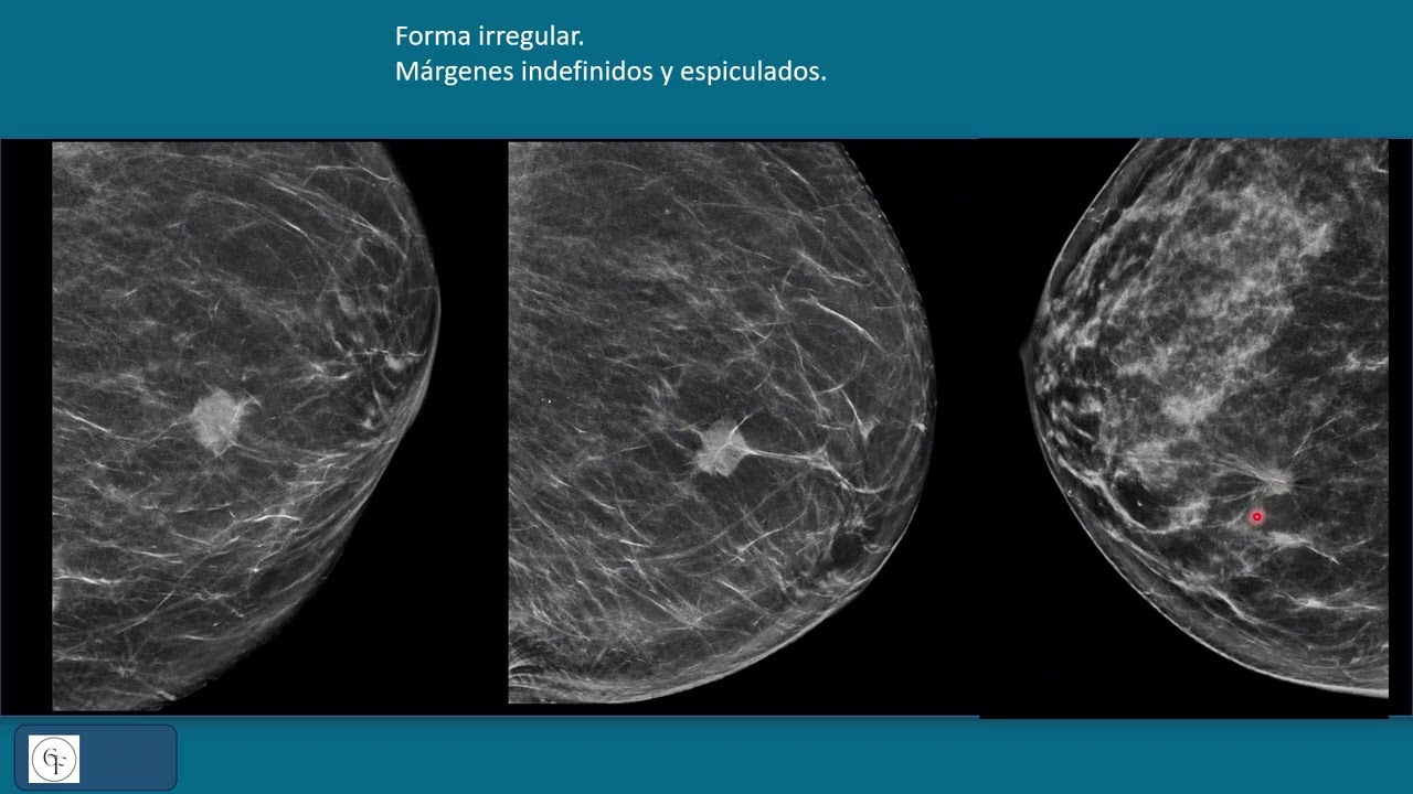 5 BI RADS MX  LEXICO  NÓDULO DISTORSIÓN ASIMETRÍA Y OTROS