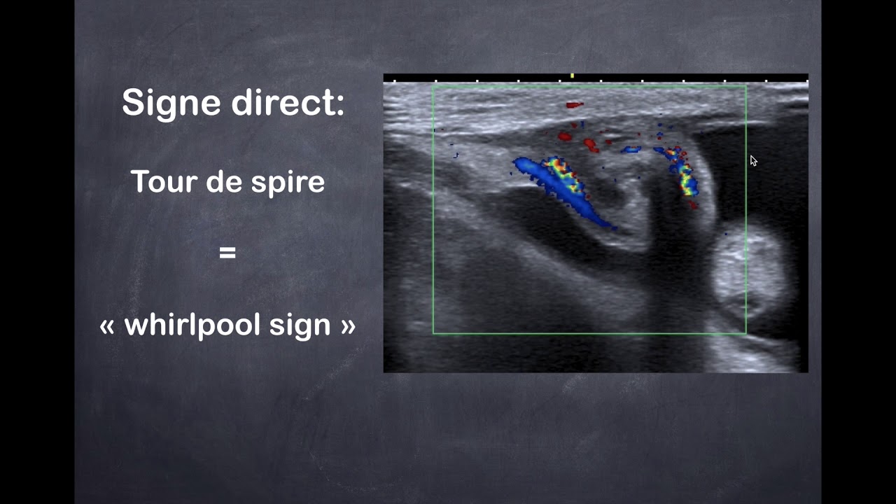 Pathologies génitaux-scrotales - 1. Torsion testiculaire