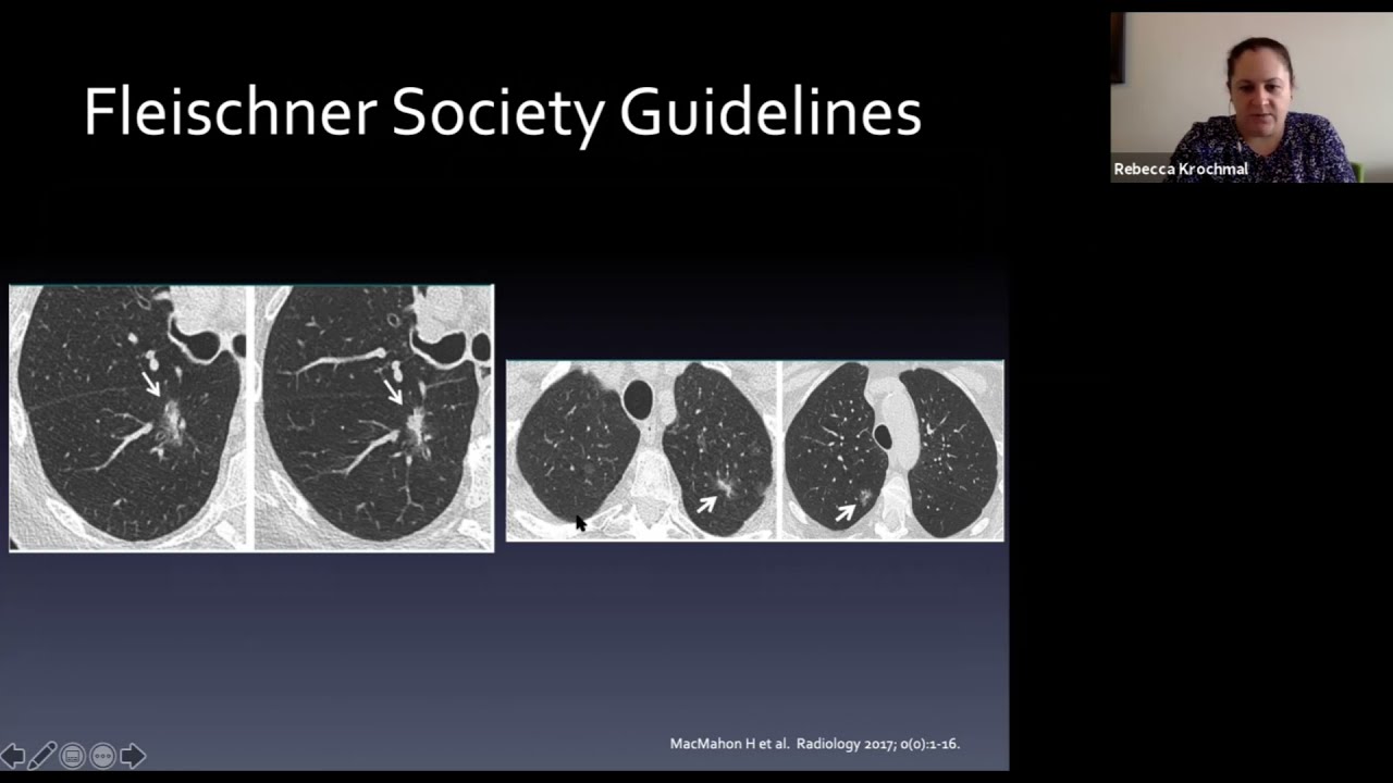 Pulmonary Nodules