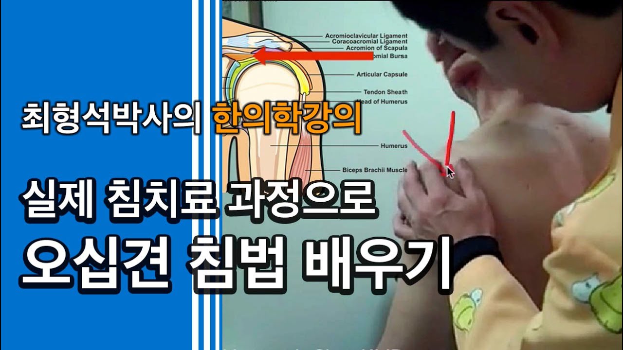 어깨통증(1)- 오십견 침치료, 실제 환자 치료방법 해설