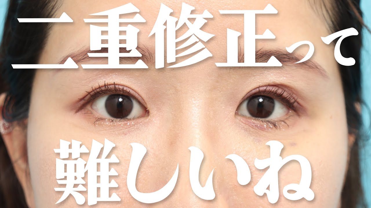 【二重整形】修正した経過について。状況をお話します。