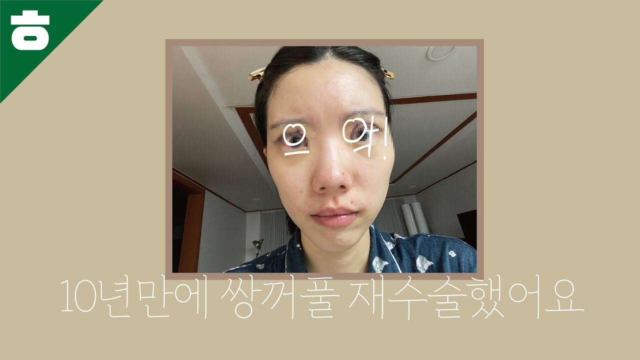 저 쌍꺼풀 재수술했어요..