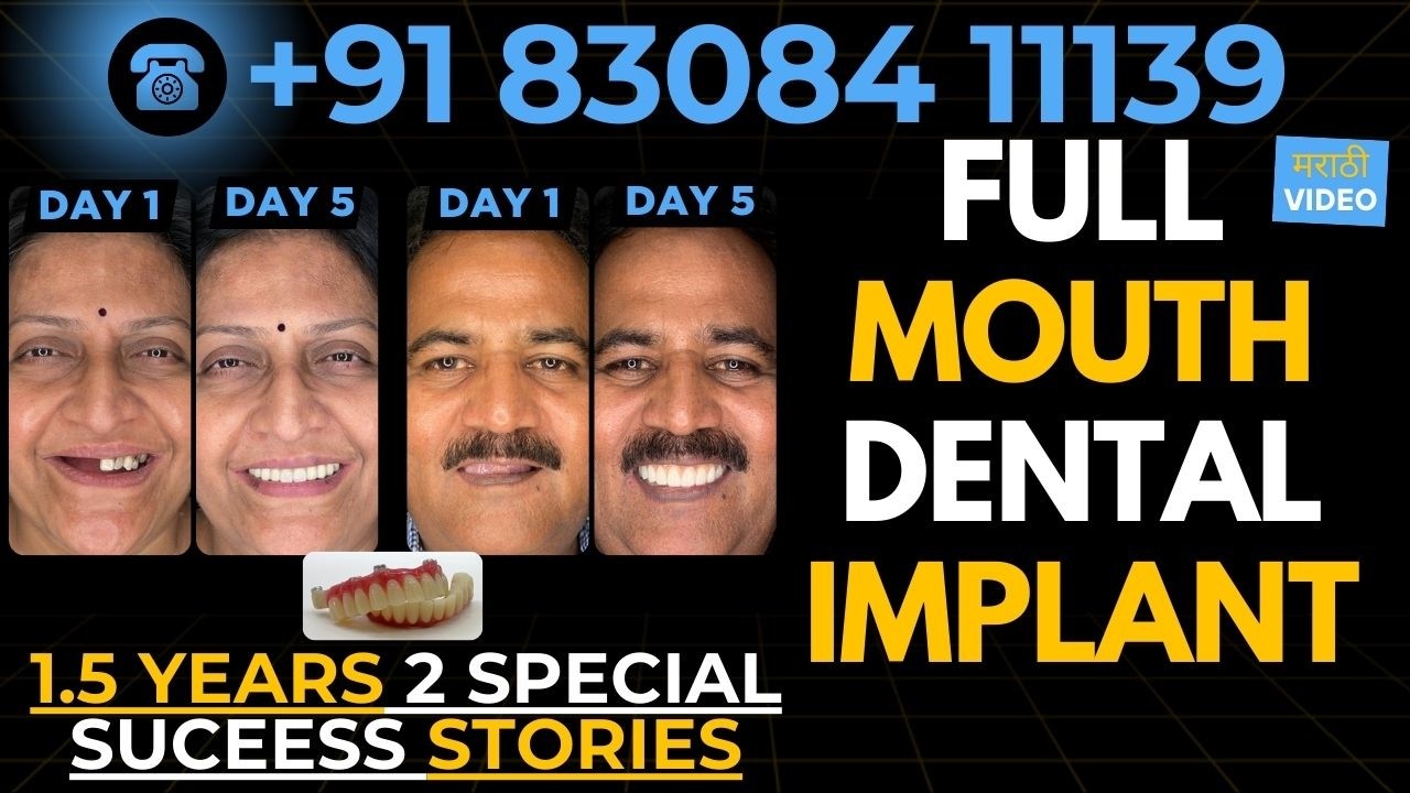 Full Mouth Dental Implants: 1.5 Years Success Story | Dr. Mayur Khairnar
