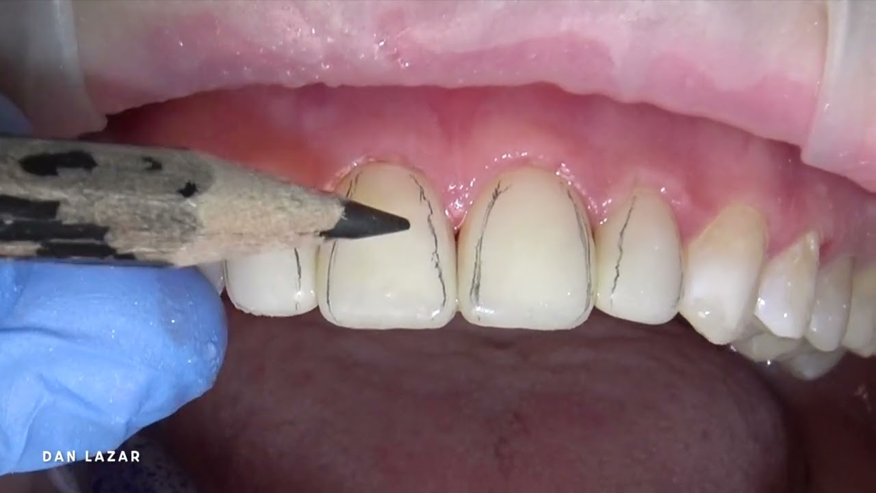 SHAPE| FINISHING - composite veneer