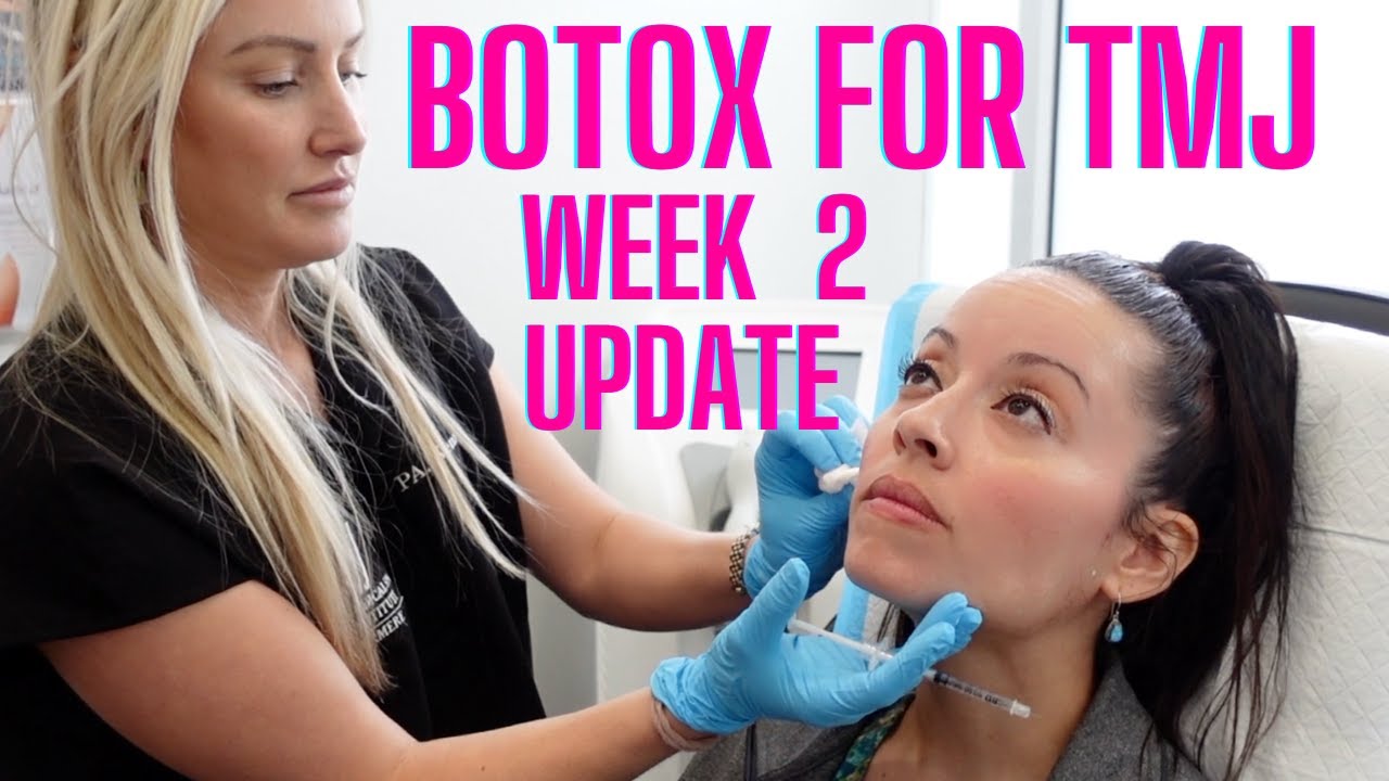BOTOX for TMJ Week 2 Update