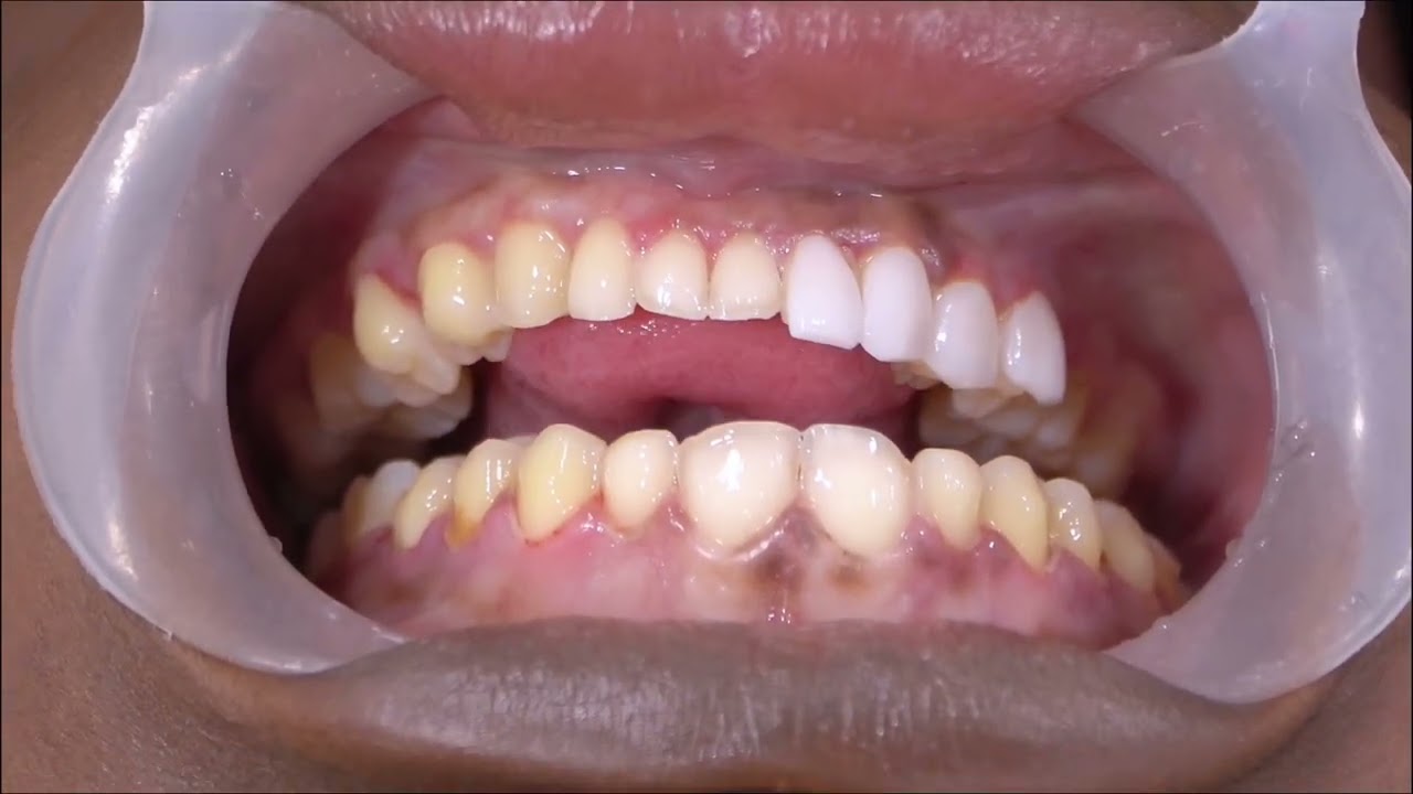 Our beautiful patients from the United States came to get their Porcelain Veneers at Dentoclub! 💎