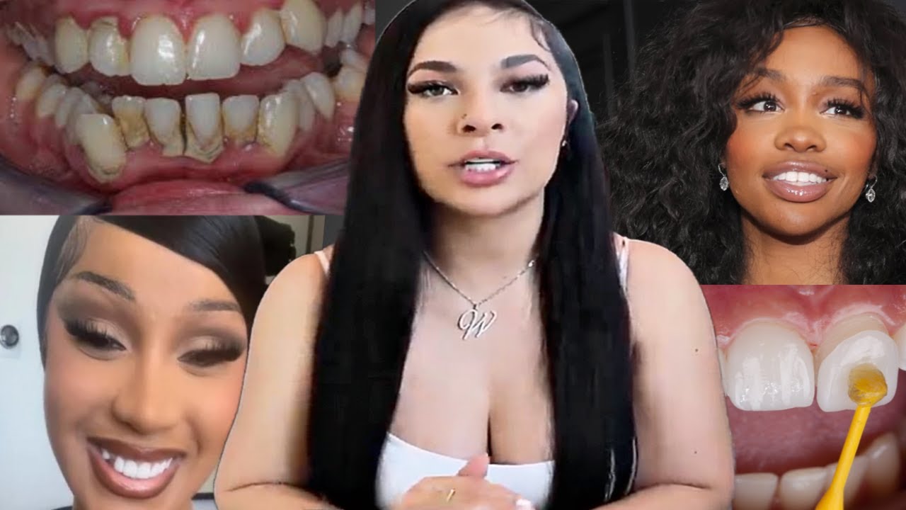 Winter Blanco EXP0SES The Dark TRUTH about Veneers -