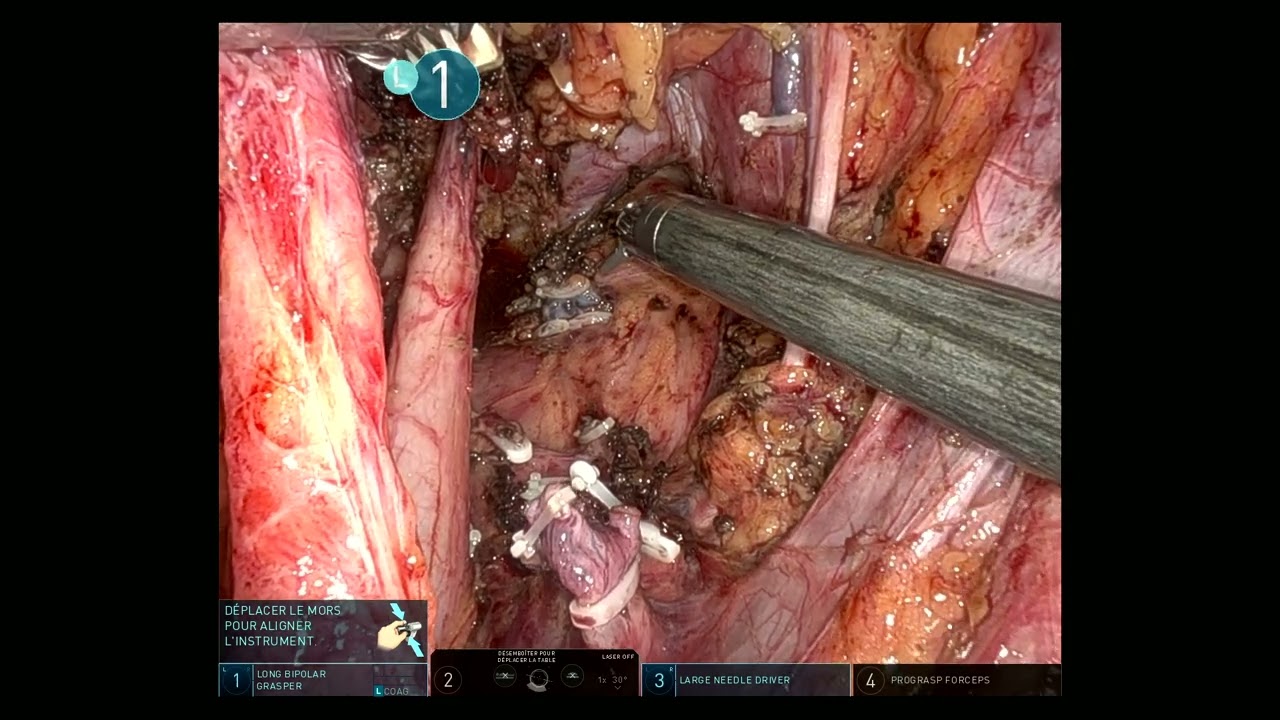 Deep endometriosis of right sacral splexus and sciatic nerve