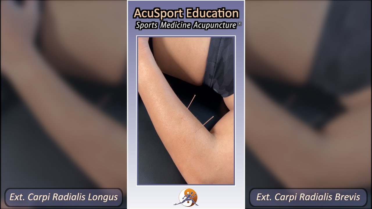Extensor Carpi Radialis Longus and Brevis - Motor Point Location, Palpation and Needling