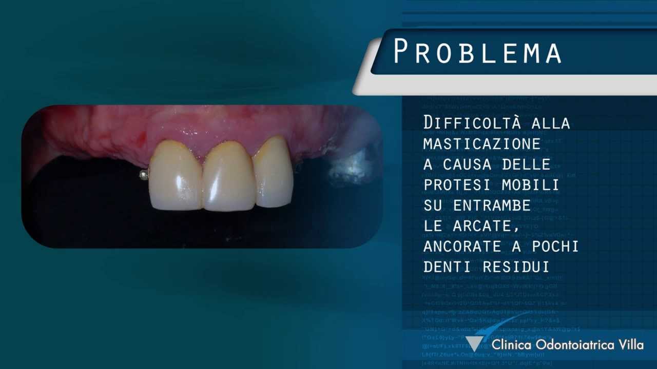 Implantologia dentale a carico immediato estetico OnlyOne®