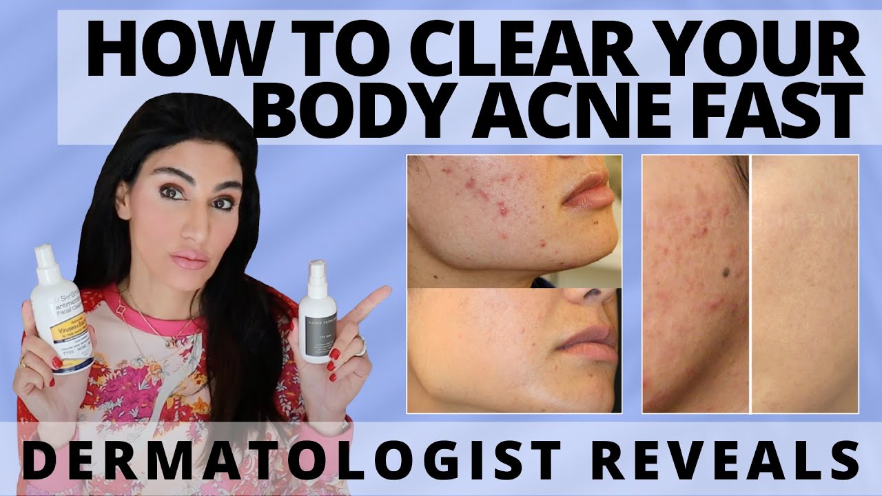 How To Clear Body Acne Fast | Dermatologist Reveals #acne #acnetreatment