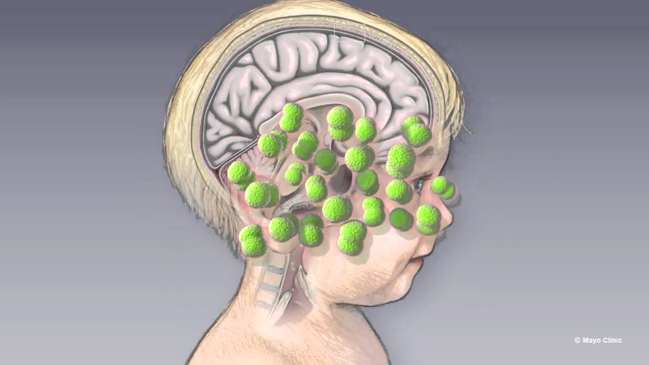 Managing Meningitis - Mayo Clinic