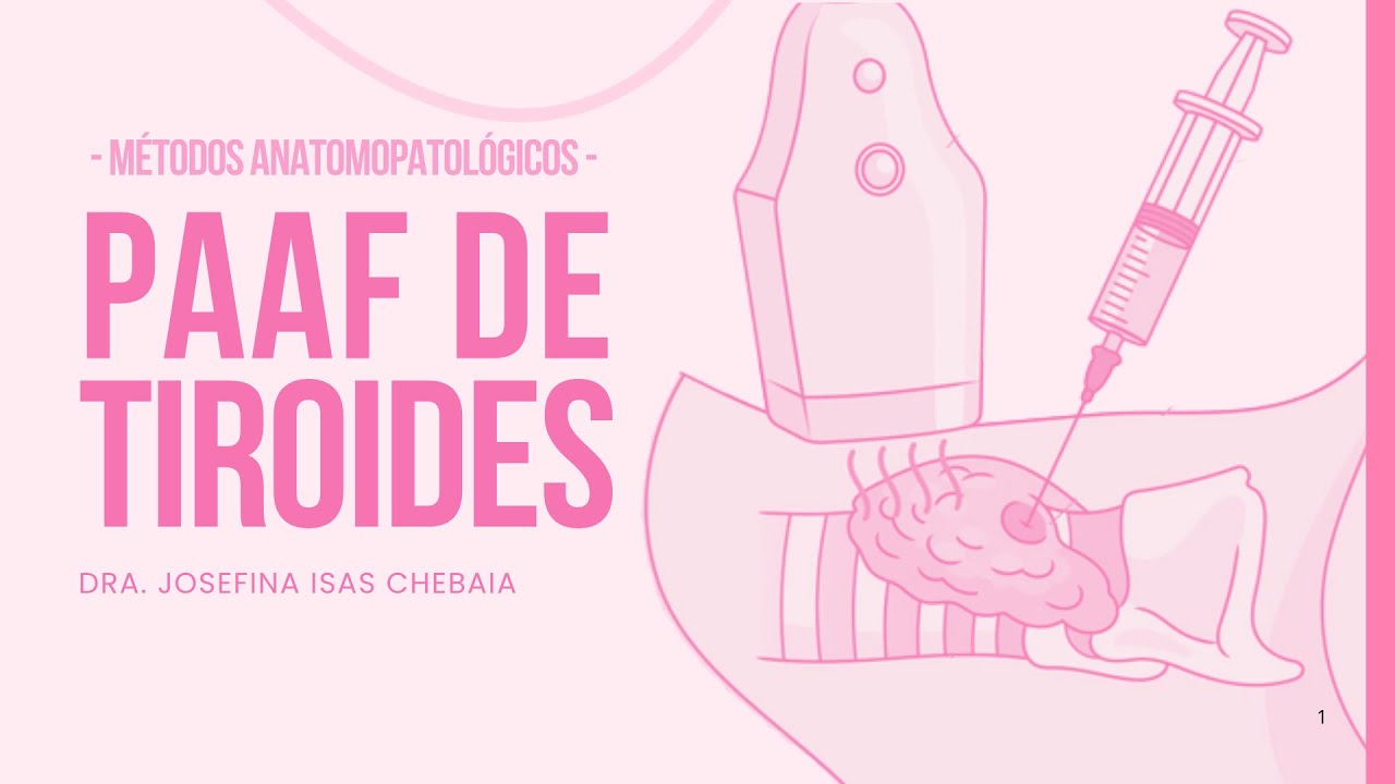 PAAF de tiroides: explicado paso a paso | Citología tiroidea