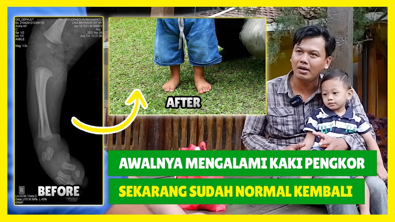 BERBAGI PENGALAMAN DALAM MERAWAT ANAK DENGAN KONDISI CTEV (KAKI PENGKOR) SEJAK LAHIR