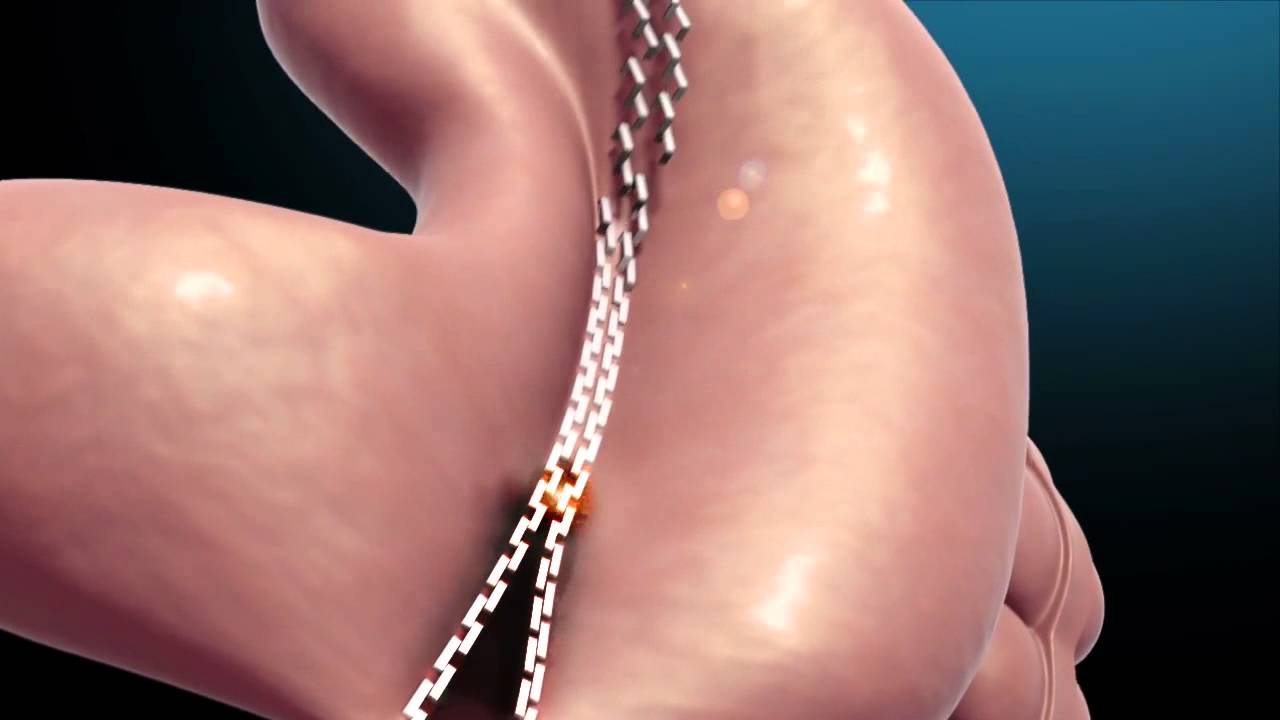 Gastrectomia vertical o manga g&aacute;strica