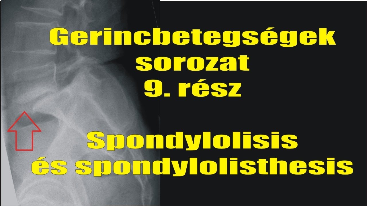 Gerincbetegs&eacute;gek sorozat 9. r&eacute;sz: Spondylolysis &eacute;s a spondylolisthesis