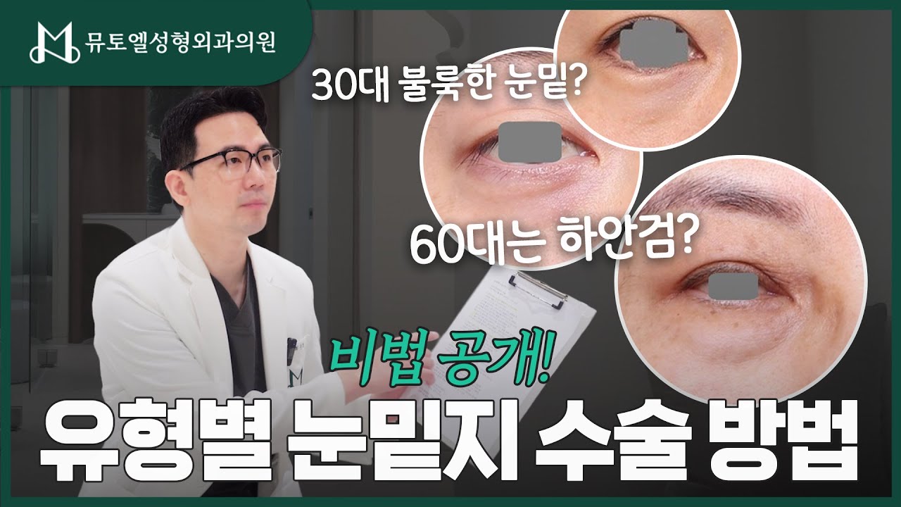 눈밑지방재배치 유형별로 비법 공개합니다! #성형외과 #성형외과의사 #눈가주름 #눈밑지방재배치 #하안검 #하안검수술 #눈밑지방 #눈밑지방제거 #지방이식 #눈밑꺼짐 #눈밑지 #눈밑필러