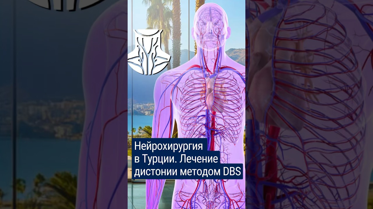 Революционное лечение дистонии в Турции методом DBS. #shorts #медицинавтурции #лечениевтурции