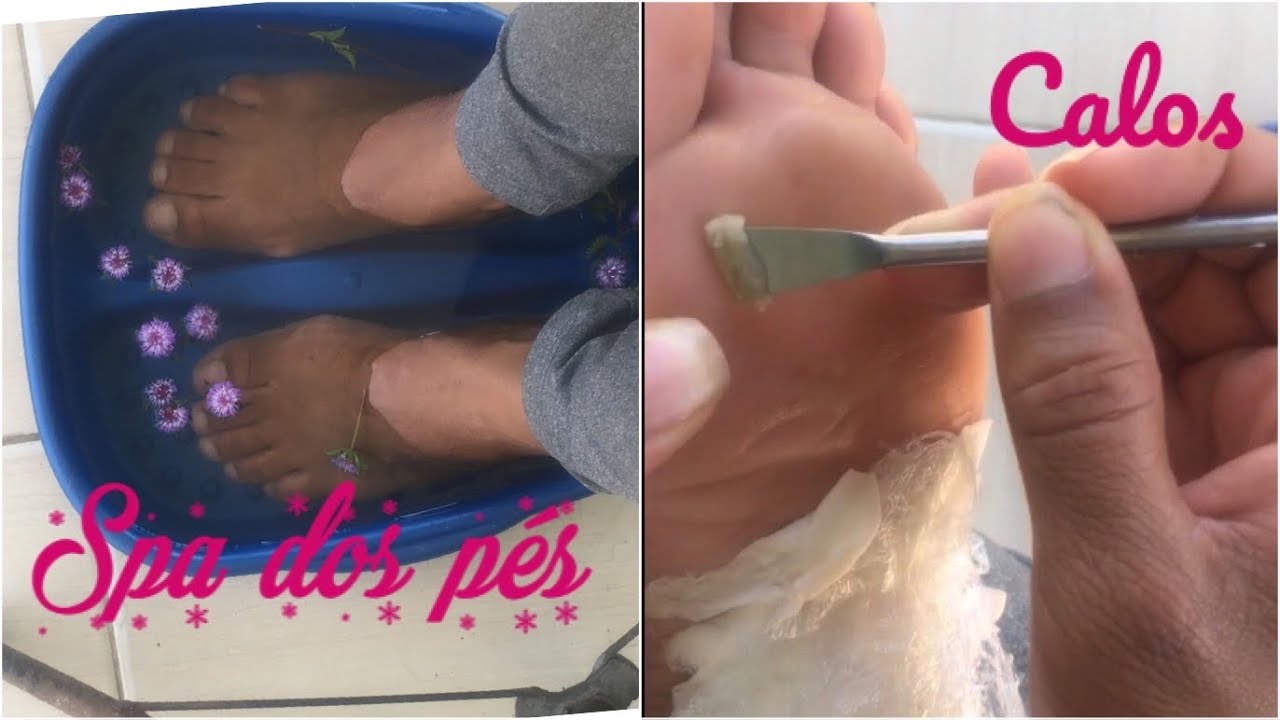 SPA DOS PÉS 🦶 passo a passo REMOVENDO CALOSIDADE