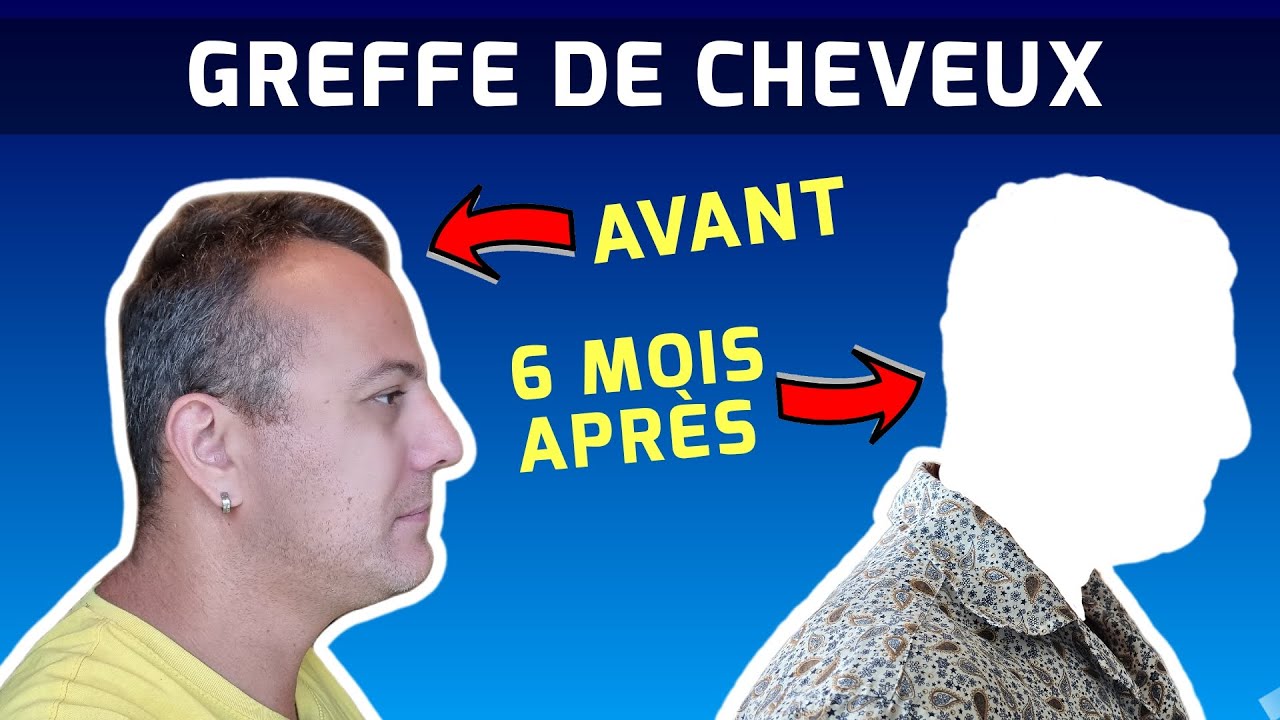 Ma greffe de cheveux, 6 mois plus tard, où cela en est?