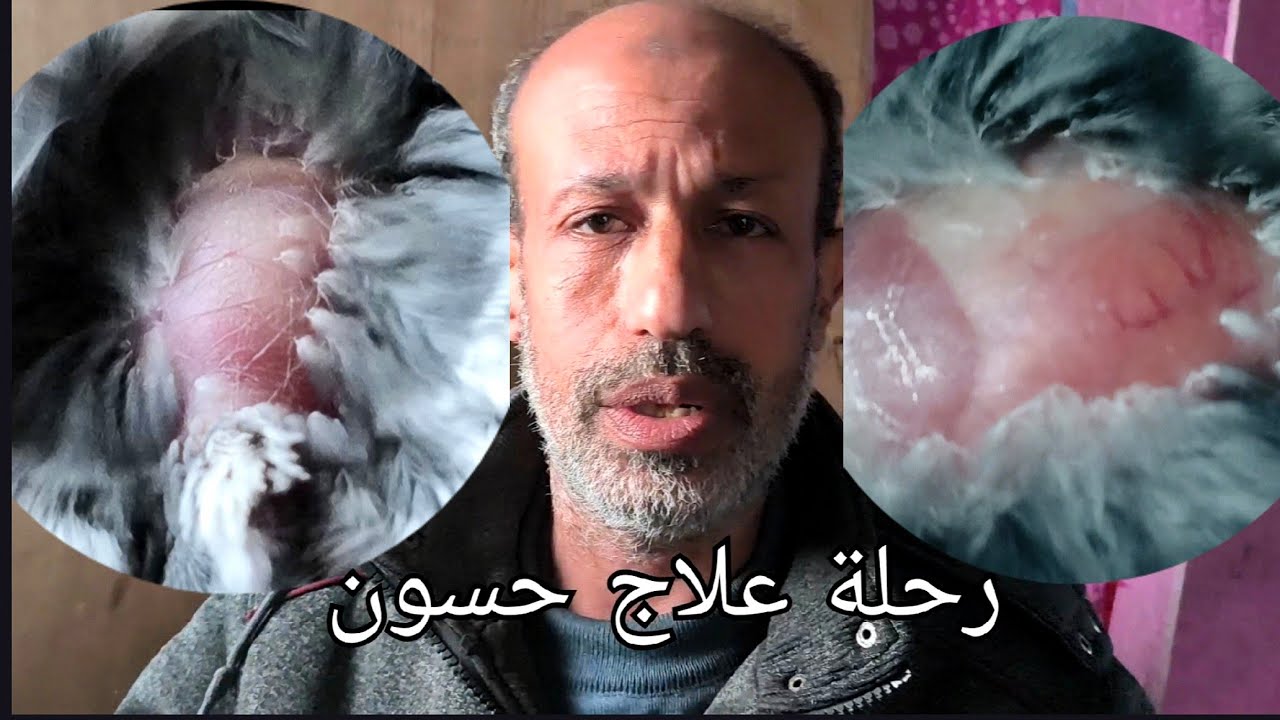 إنقاذ حياة حسون بعد رحلة شاقة من العلاج 