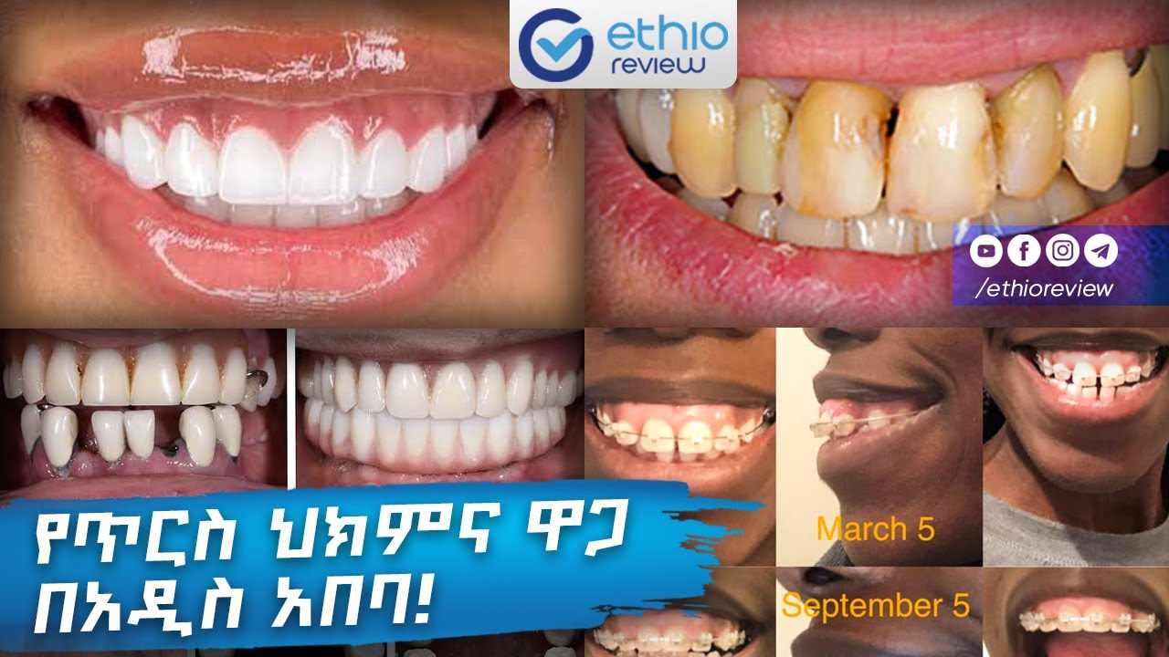 የጥርስ ህክምና ዋጋ በአዲስ አበባ! / Dental Clinic in Addis Ababa Ethiopia 2025