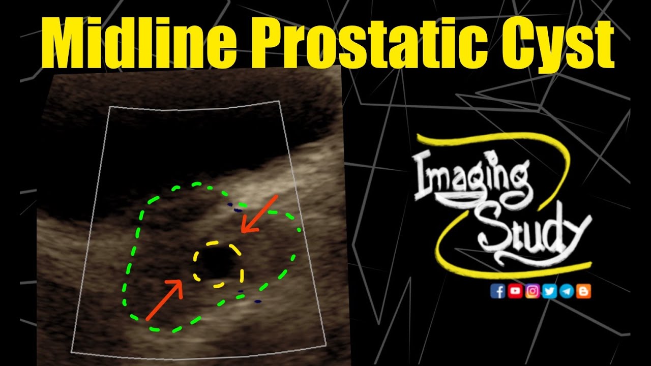 Midline Prostatic Cyst || Ultrasound || Case 302