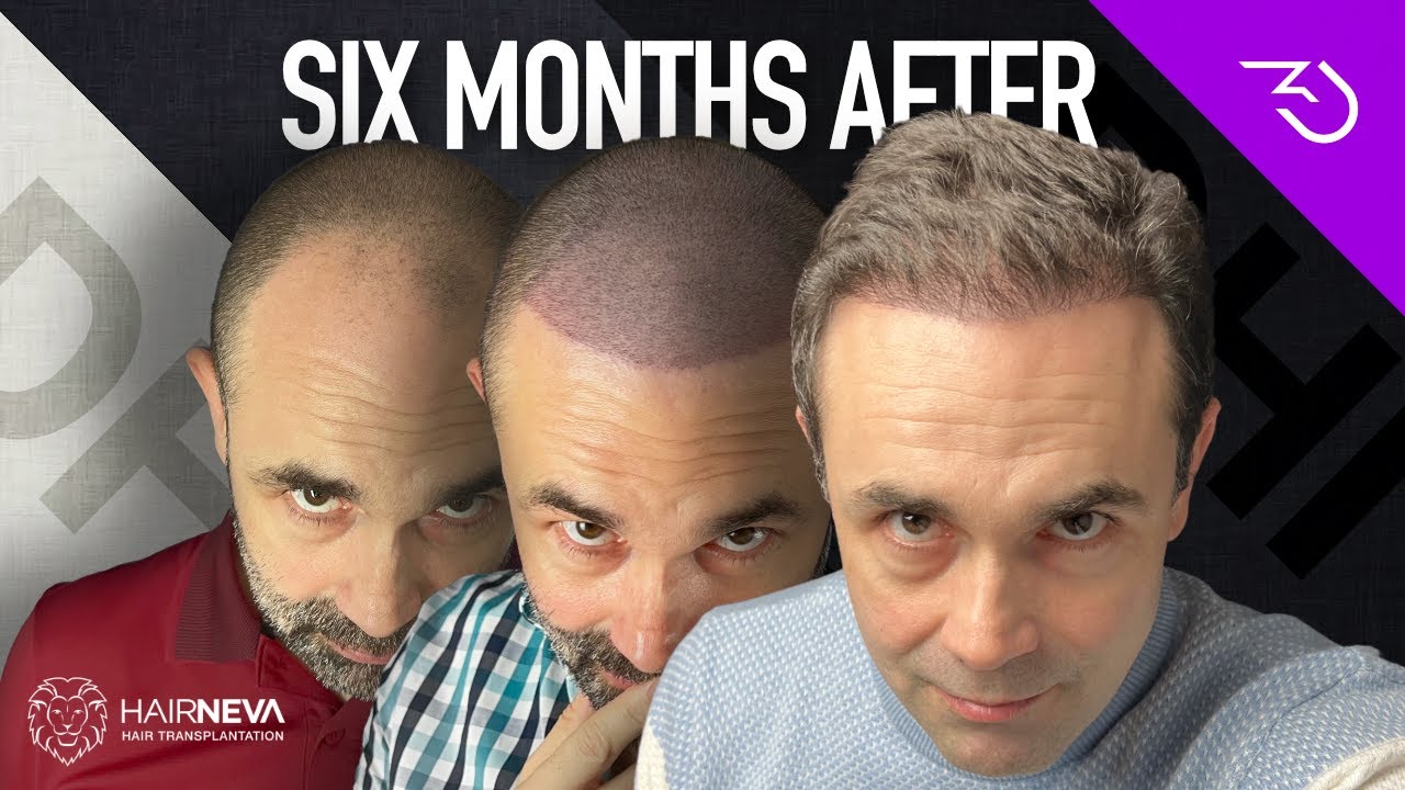 Best Hair Transplant In Turkey - DHI 6 months results