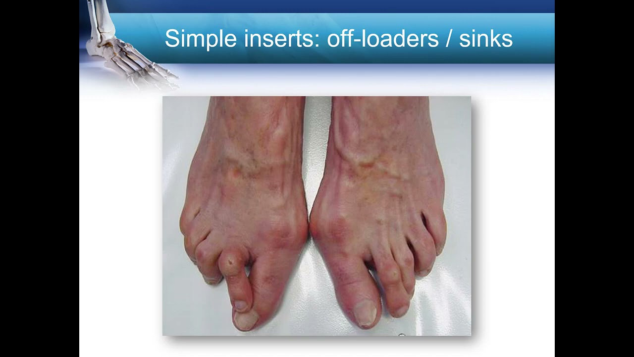 Principles of Foot and Ankle Orthoses