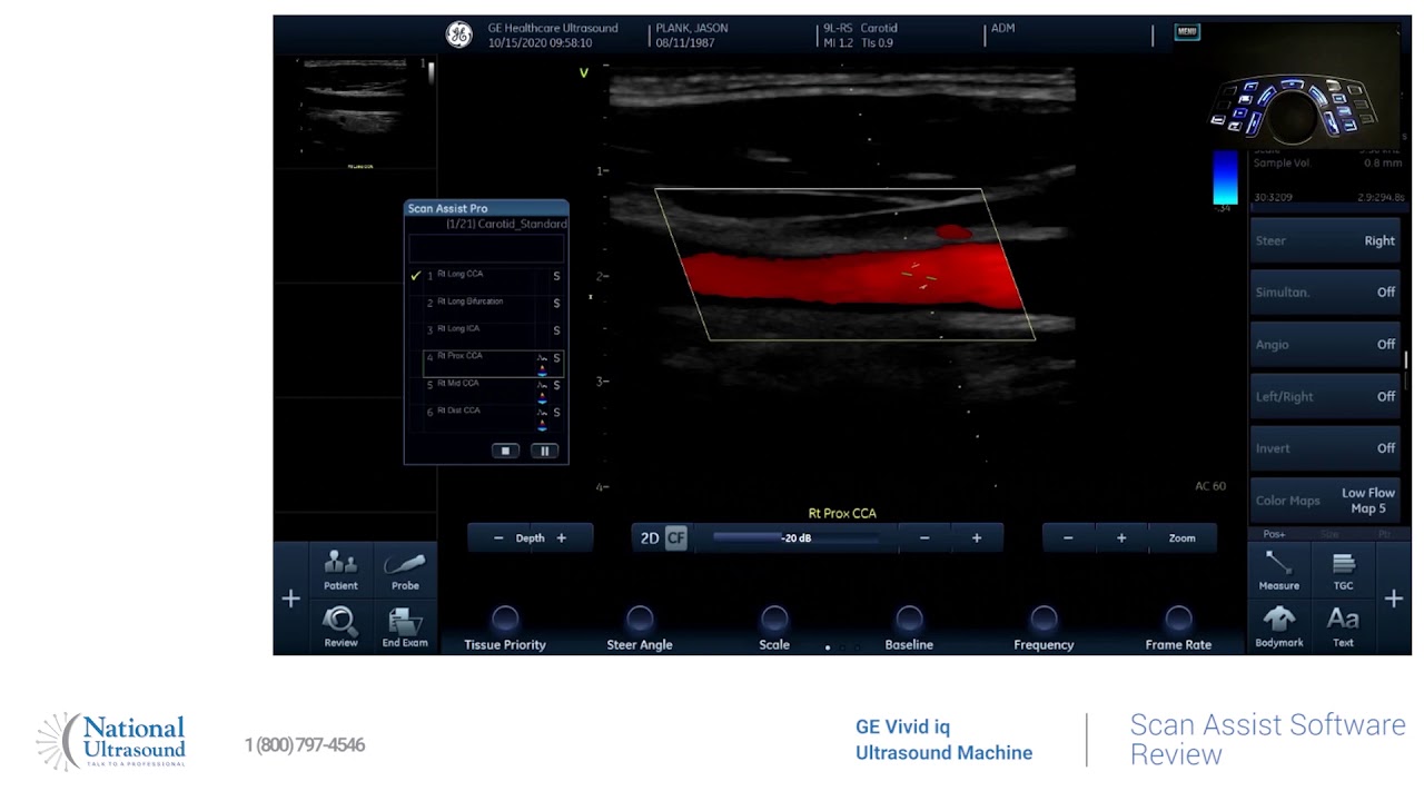 GE Vivid IQ Scan Assist Software Training Video
