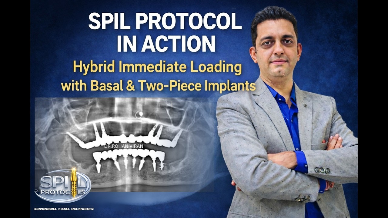 SPIL Protocol in Action: Hybrid Immediate Loading with Basal & Two-Piece Implants