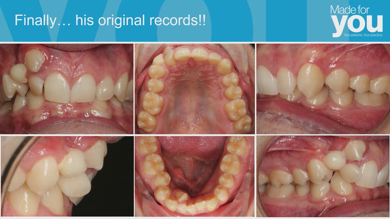 Winner at Summit Invisalign 2018 Case Shootout  Dr Christian Fournier