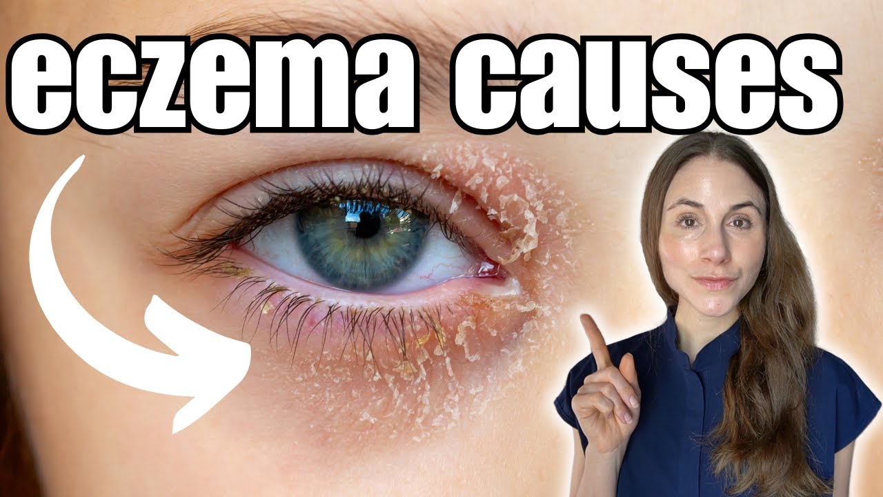 Causes And Treatment Of Eyelid Eczema Explained