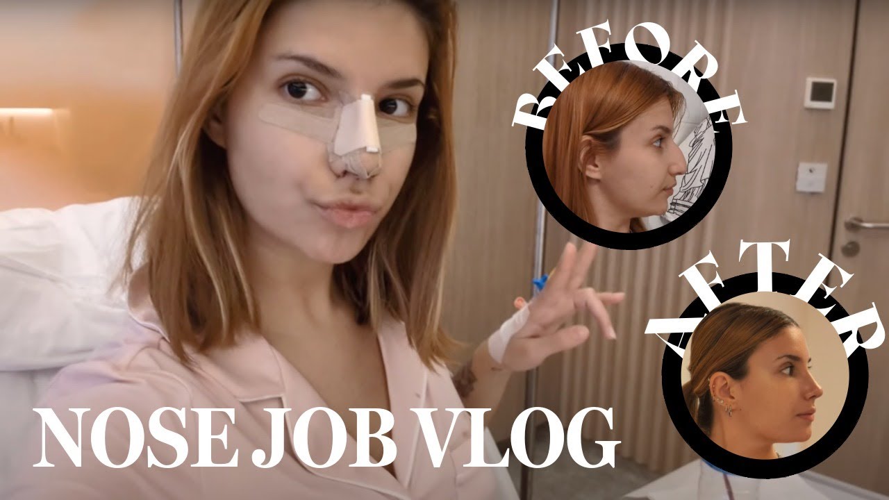 My Istanbul Nose Job Vlog 🇹🇷 | Summer Rhinoplasty Journey + Before & After