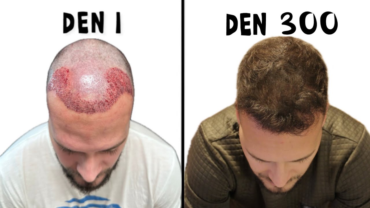 Celý proces Nastřelení Vlasů, PŘED A PO / STOJÍ TO ZA TO?