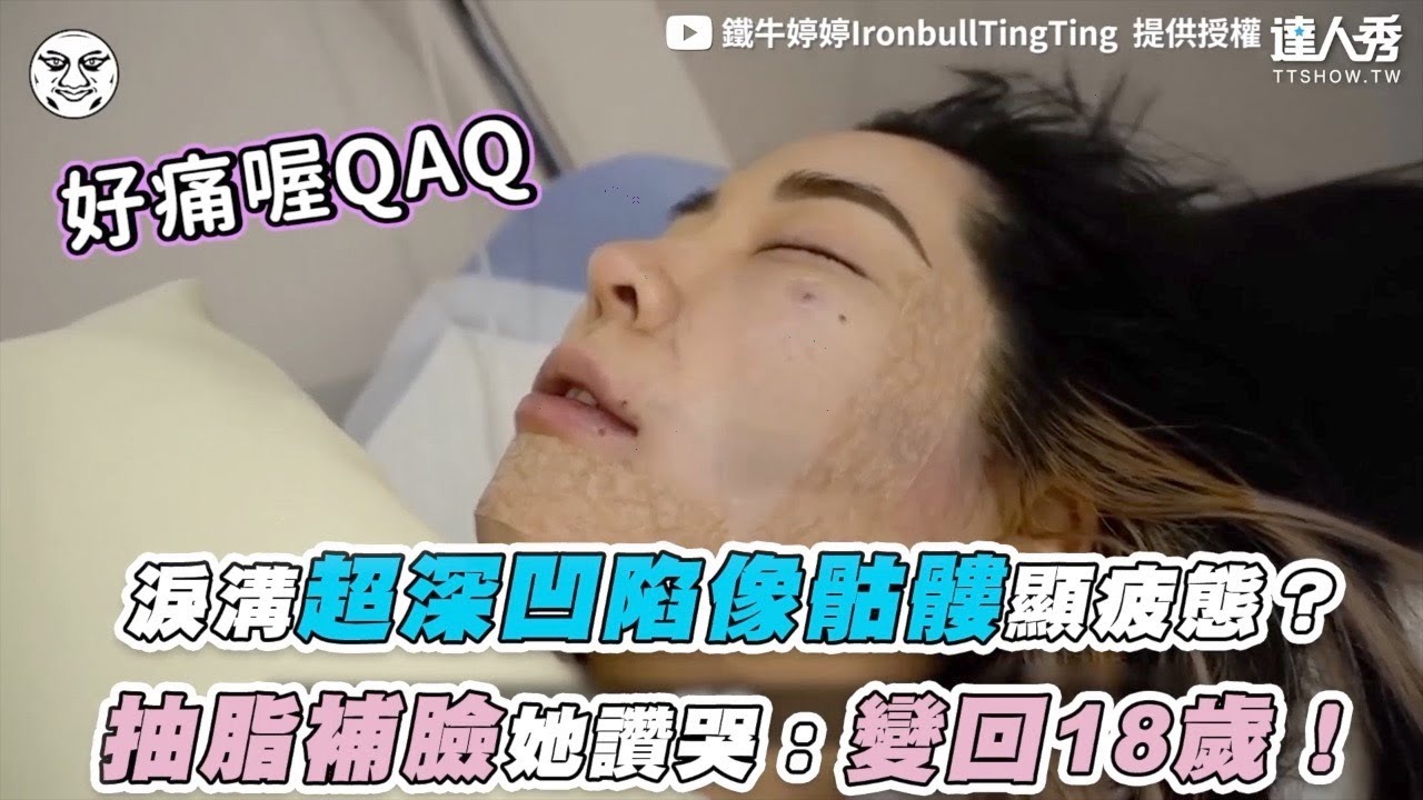 【淚溝超深凹陷像骷髏顯疲態？ 抽脂補臉她讚哭：變回18歲！】｜@ironbulltingting