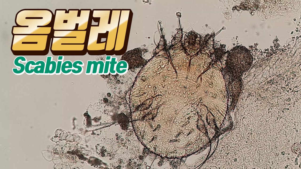 옴벌레 '병원 입원할때 조심하세요!' 한번 걸리면 골치아픈 곤충 Scabies mite,옴치료법,옴예방법 [전염병][옴]