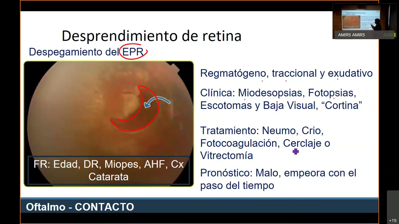 ENARM 2021 Oftalmología REVISIÓN DE TEMAS