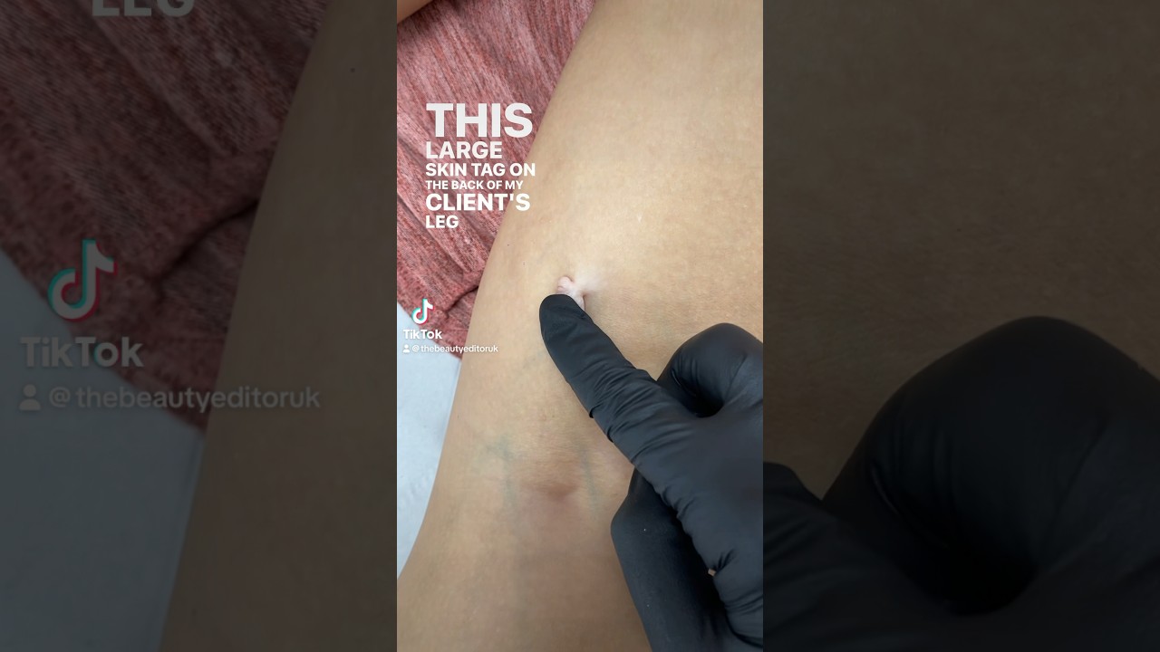 Skin Tag Removal Results! - Before & After 1 treatment of Electrocautery! #skintagremoval